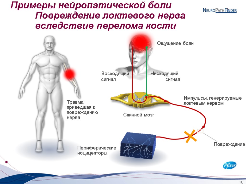 10 Примеры нейропатической боли Повреждение локтевого нерва вследствие перелома кости Восходящий сигнал Нисходящий сигнал